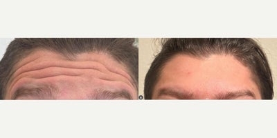 35-44 year old man treated with Dysport - Treated with Dysport 40+ units