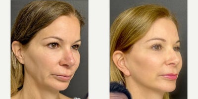 45-54 year old woman treated with Brow Lift, Deep Plane Facelift, Neck Lift, Facial Fat Transfer - Another beautiful example of my Define lift. You can see the natural elevation of her brows giving her some upper eyelid show without needing a blepharoplasty. Her jawline and her cheeks are elevated due to my extended deep facelift, as well as judicious fat grafting to the midface. Her neck is clean and crisp. This is due to my deep neck lift which I adjusted the glands to tighten the muscles of the platysma, she is in her late 40s or early 50s and this is the perfect time for an intervention because her collagen and elastin are still good. She still looks amazing and the lift will be durable and last for several years. This is the defined lift difference subtle but substantial.