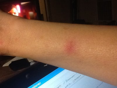 Red (Spider Bite Looking) Bumps Post Dot Smartxide Laser ...