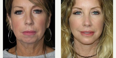 Woman treated with Genioplasty - Woman treated with Genioplasty