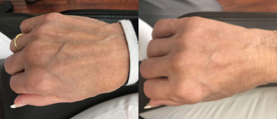 65-74 year old woman treated with Hand Rejuvenation using Radiesse - Hand Rejuvenation using Radiesse