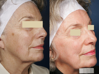 Fraxel Repair - Before and 10 months after Fraxel repair - fractional ablative CO2 laser. GentleLase 755 nm alexandrite laser was used to treat the dark sun spot on the cheek after healing from the Fraxel repair.