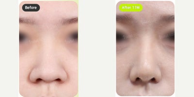 18-24 year old woman treated with Alarplasty, Cheek Fillers - 18-24 year old woman treated with Alarplasty, Cheek Fillers