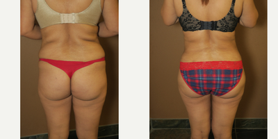 35-44 year old woman treated with Brazilian Butt Lift - brazilian buttock lift and liposuction of flanks, abdomen