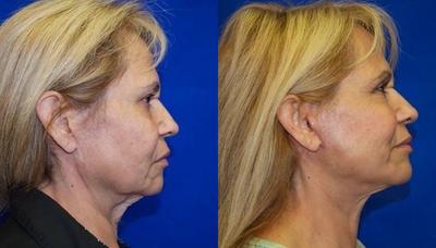 Woman over 60 years old treated with Laser Resurfacing - Woman over 60 years old treated with Laser Resurfacing