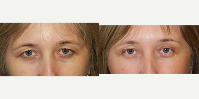 35-44 year old woman treated with Brow Lift - endoscopic brow lift