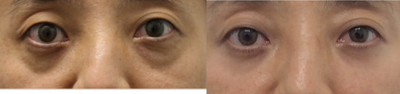 Asian male before and 3 years after lower blepharoplasty with fat grafting - He underwent transconjunctival lower eyelid blepharoplasty with fat grafting to under eye hollows and cheeks. Results 3 years later.