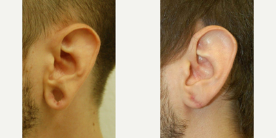18-24 year old woman treated with Ear Lobe Surgery - This gentleman, in his early 20s, needed an earlobe repair. This was performed in the office, under local anesthesia. He was pain free during the procedure. These postoperative pictures are taken at only 3 weeks. His scar will fade over the next several weeks.