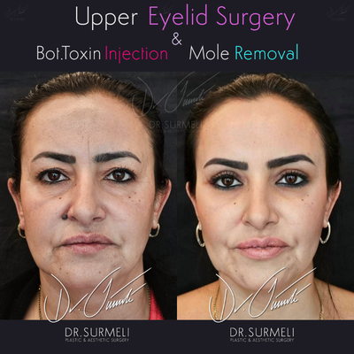 45-54 year old woman treated with Eyelid Surgery, Skin Rejuvenation, Botox, Mole Removal - 47-year-old woman treated with uppper blepharoplasty (upper eyelid surgery), Botox injections, mole removal.