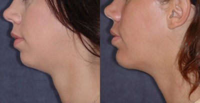Chin augmentation - Goretex chin implant