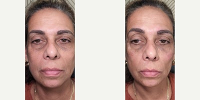 45-54 year old man treated with Belotero, Restylane Refyne, Juvederm, Dermal Fillers, Skin Rejuvenation - Undereye rejuvenation with Hyaluronic acid filler