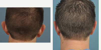 35-44 year old man treated with Ear Surgery - This young man had a very natural look to his ears after Otoplasty.