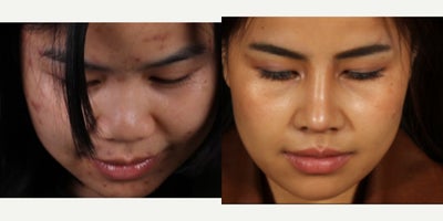 25-34 year old woman treated with Rhinoplasty, Asian Rhinoplasty - 3 weeks after rhinoplasty with rib graft for our beautiful patient! She is recovering so well and we could not wait any longer to get her photos out there. We borrowed her rib and deeper soft tissue to create a bridge with an onlay graft and project her tip with the extra cartilage. We still have more swelling we expect to resolve with more time, especially above her tip and we can't wait for it to continue to narrow. Thanks to her for allowing us to share!