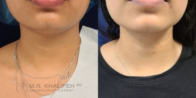 35-44 year old woman treated with Smart Lipo - Another example of a clean jaw line, both submental and angle of mandible, to bring out this patient's natural beauty in a one hour smartlipo procedure.