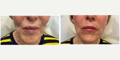 75 and up year old woman treated with Volbella, Lip Fillers, Dermal Fillers, Chin Filler - This patient desired more plump and hydrated lip appearance.  1cc of Juvederm Volbella dermal filler was used to achieve a more defined and fuller lip appearance.She also underwent injections of Bellafill long-lasting dermal filler to the jowls and marionette lines to create a more youthful lower face appearance.