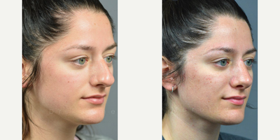 Woman treated with Rhinoplasty - 1 year Rhinoplasty follow up and this patient