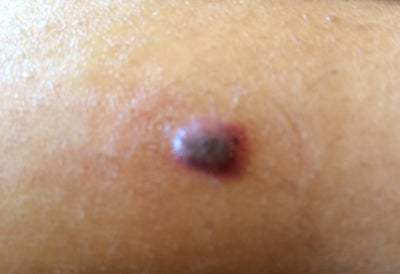 Hypertrophic scar steroid injection