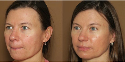 Woman treated with Brow Lift - Woman treated with Brow Lift