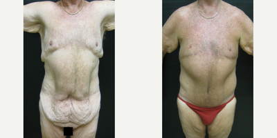 62 year old man treated with Male Tummy Tuck - Gynecomastia and CBL after massive weight loss