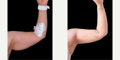 35-44 year old woman treated with Vaser Liposuction - Arm Vaser Liposuction, 1,2 litres of fat removed