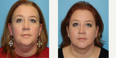 45-54 year old woman treated with Neck Lift - Limited incision neck and face lift designed not to move back the temporal hairline. Notice her improved jaw line and chin contour