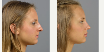 18-24 year old woman treated with Rhinoplasty - 23 year old with nasal hump and bulbous tip.