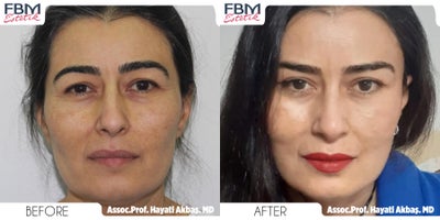 35-44 year old woman treated with Mini Facelift, Mini Neck Lift, Eyelid Surgery, Breast Fat Transfer - 35-44 year old woman treated with Mini Facelift, Mini Neck Lift, Eyelid Surgery, Breast Fat Transfer