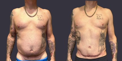 45-54 year old man treated with Male Tummy Tuck, Liposuction, Tummy Tuck - This 48 year old man is 5'6 tall and weighs 166 pounds. He had an abdominoplasty, (tummy tuck), and liposuction performed.