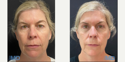 45-54 year old woman treated with Eyelid Surgery - This patient received a Blepharoplasty on both eyelids.