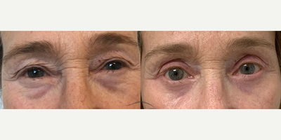 66 year old woman treated with CO2 Laser - 66 year old woman treated with CO2 Laser