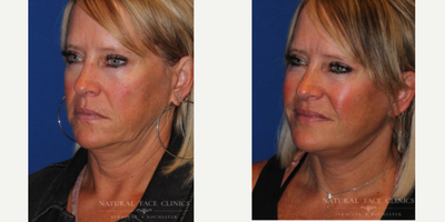 55-64 year old woman treated with Facelift, Cheek Lift - Patient concerned with jowls and loose skin.