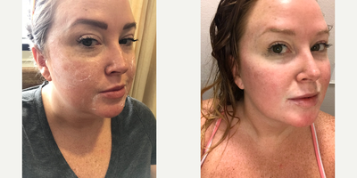 25-34 year old woman treated with Voluma - 31 year old patient concerned with the loss of volume in her cheeks and prominent marionette lines. She was injected with Voluma in her cheeks and Vollure to her marionette lines to achieve a more youthful, natural appearance.