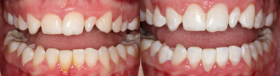 25-34 year old woman treated with Gum Lift - Patient presents to office with gummy smile and peg lateral. Before we prepped for veneers, The doctor crown lengthened patient's maxillary teeth to uncover all of the enamel that patient had underneath gums.