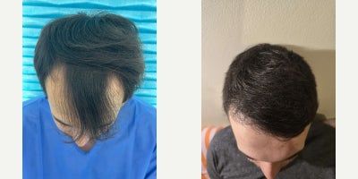 25-34 year old man treated with DHI Hair Transplant - 6 months post hair transplant approximately 40% of the final resultThis result is shown 6 months after the procedure, which represents an early growth phase and approximately 40% of the final expected outcome. At this stage, transplanted hair is still maturing density, thickness, and overall texture will continue to improve over the next several months.The photos present the frontal area and temporal zones, with additional views from the side profile, allowing for an objective assessment of hairline design, direction, and early density.Final results are typically evaluated between 12 and 15 months after the procedure, once full hair maturation is complete.