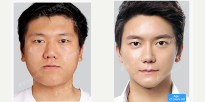 25-34 year old man treated with AccuLift - Accu-lift+NANO Bimaxillary Diorthosis+Natural V-line+Cheekbone Shaping+Forehead Shaping+Rhinoplasty+Blepharoplasty