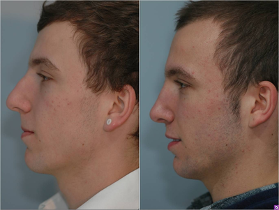 Rhinoplasty - The patient was unhappy with the bump or dorsal hump on his nose. In addition, his nose was overly projected.Following an open septorhinoplasty technique, he has a straight, masculine profile with a reduced bridge and tip that flows nicely and fits well with his facial features.