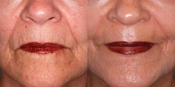 peel tca redness