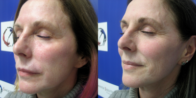 ipl - Ipl Before And After