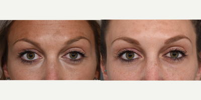 25-34 year old woman treated with Botox - 25-34 year old woman treated with Botox to her forehead lines.
