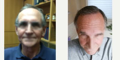 65-74 year old man treated with ARTAS Robotic Hair Transplant - Patient wanted to firm up his hairline and add density in an age appropriate fashion. We placed 1600 grafts in the front and top with Robotic Harvesting and Robotic Site making