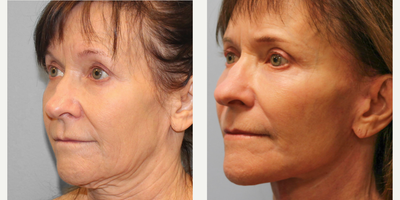 55-64 year old woman treated with CO2 Laser - This patient has undergone many of the typical age-related changes to her face. She desired improvement of her facial aging including the sagging of the face and neck, the excess skin of her upper eyelids, as well as the texture, tone and fine wrinkles of the face. She elected to proceed with facelift, upper blepharoplasty (eyelid lift), as well as CO2 laser resurfacing of the face. Our goals were to give her a nice, fresh, rejuvenated appearance.She is shown before and 4 months after her surgery.