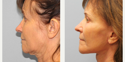 55-64 year old woman treated with Facelift, Eyelid Surgery, CO2 Laser - This patient has undergone many of the typical age-related changes to her face. She desired improvement of her facial aging including the sagging of the face and neck, the excess skin of her upper eyelids, as well as the texture, tone and fine wrinkles of the face. She elected to proceed with facelift, upper blepharoplasty (eyelid lift), as well as CO2 laser resurfacing of the face. Our goals were to give her a nice, fresh, rejuvenated appearance.She is shown before and 4 months after her surgery.