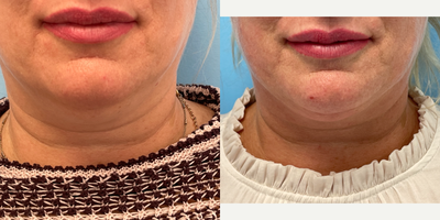 45-54 year old woman treated with ThermiTight - 51 year old female underwent ThermiTight surgery under general anesthesia