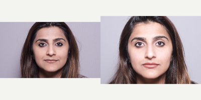 18-24 year old woman treated with Juvederm - 18-24 year old woman treated with Juvederm