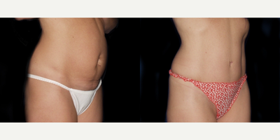 25-34 year old woman treated with Tummy Tuck - 3 months post op