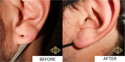 Man treated with Earlobe Repair - Man treated with Earlobe Repair