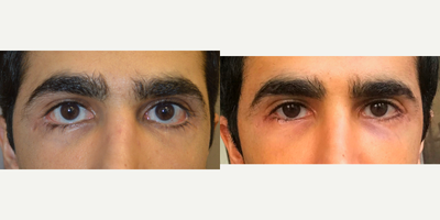 Young male, underwent revision lower eyelid retraction surgery. - 27 year old male, with history of multiple lower eyelid operations with severe lower eyelid retraction, sclera show and eyelid scarring, underwent revision lower eyelid retraction surgery (internal lift, soof lift, alloderm spacer graft, canthoplasty, scar revision). Before and 2 months after revision eyelid surgery photos are shown. (The after photo is a selfie.)