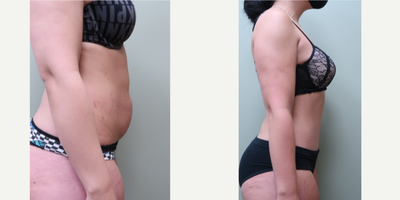 25-34 year old woman treated with Tummy Tuck - Abdominoplasty with muscle plication and liposhaping