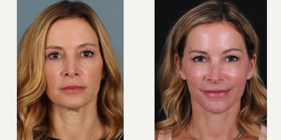45-54 year old woman treated with Mini Facelift, MACS Facelift, SMAS Facelift - MACS facelift, mini-facelift B&A.