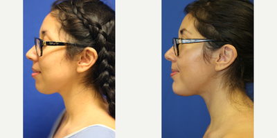 25-34 year old woman treated with Chin Implant - This patient in her mid-twenties was unhappy with the size of her chin. She had what we call a weak or receding chin. A chin implant was used to balance her facial features and improve her profile. The patient is happy with her new chin.